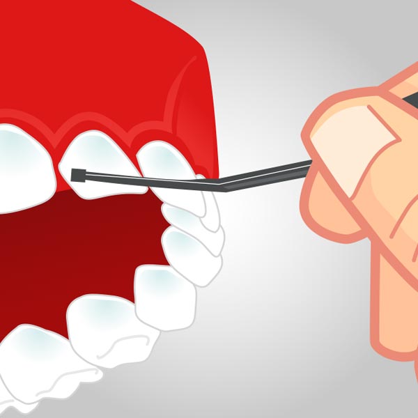 Uso de traxodent (hemostático y retractor)